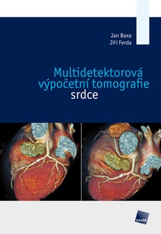 Multidetektorová výpočetní tomografie srdce