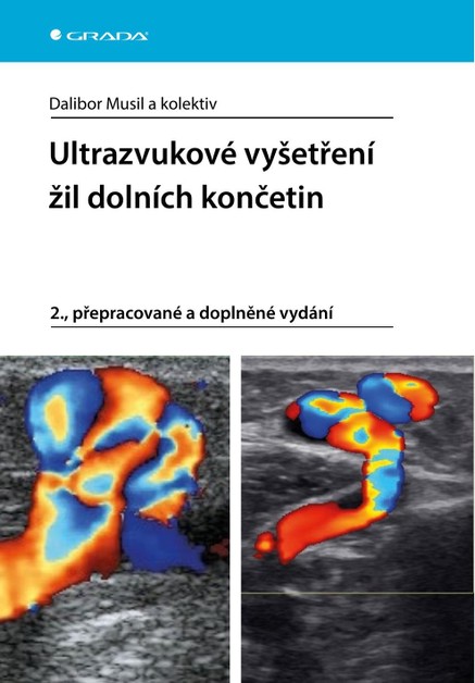 Ultrazvukové vyšetření žil dolních končetin